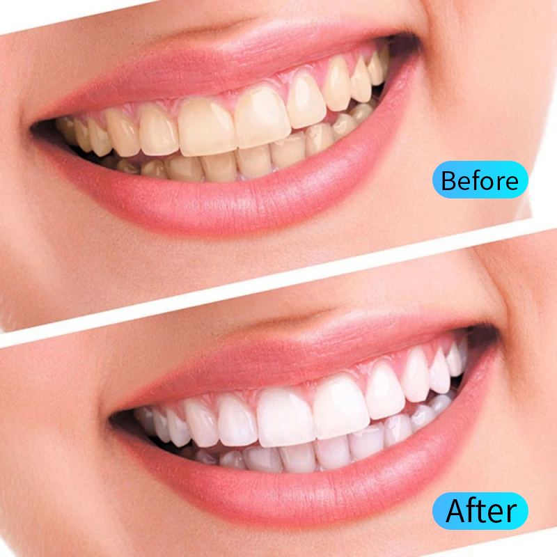 Kit de Gel para blanquear los  - Teeth Whitening Filter reseña y precio