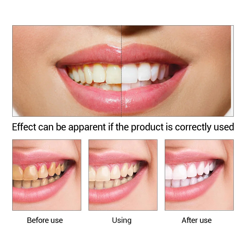 FTEENPLY-esencia para blanquea - Teeth Whitening App reseña y precio