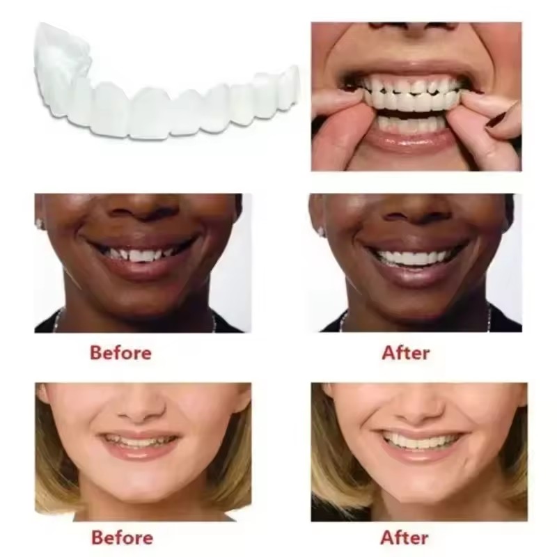 Carillas Dentales, Blanqueamie - Teeth Whitening Veneers reseña y precio