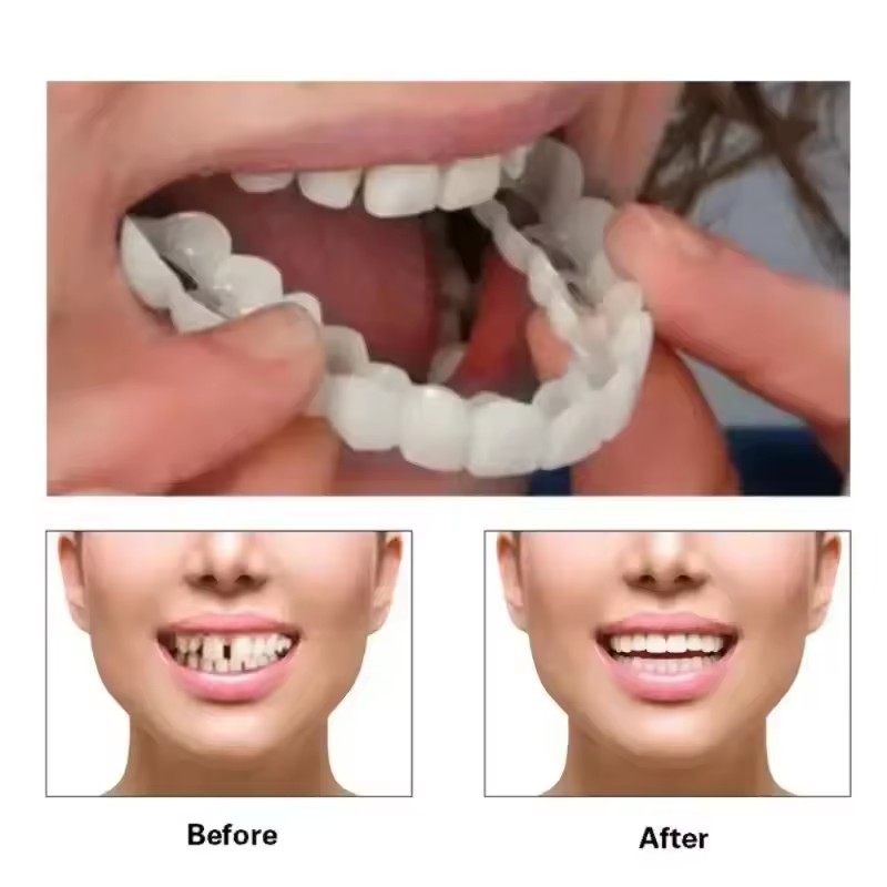 Carillas Dentales, Blanqueamie - Teeth Whitening Veneers reseña y precio