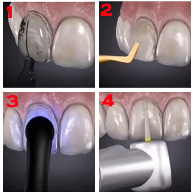 Molde Dental para Carillas de  - Teeth Whitening Veneers reseña y precio